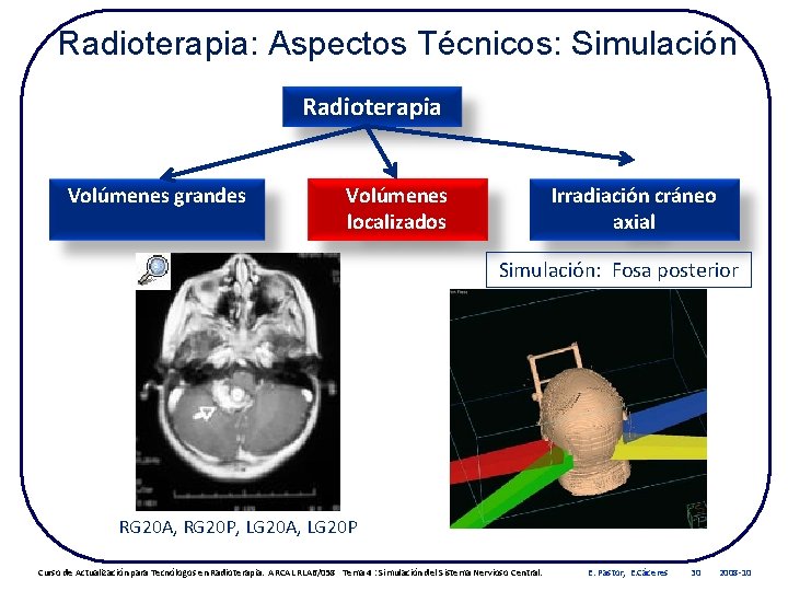Radioterapia: Aspectos Técnicos: Simulación Radioterapia Volúmenes grandes Volúmenes localizados Irradiación cráneo axial Simulación: Fosa