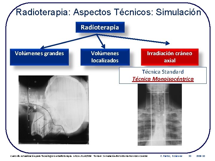Radioterapia: Aspectos Técnicos: Simulación Radioterapia Volúmenes grandes Volúmenes localizados Irradiación cráneo axial Técnica Standard