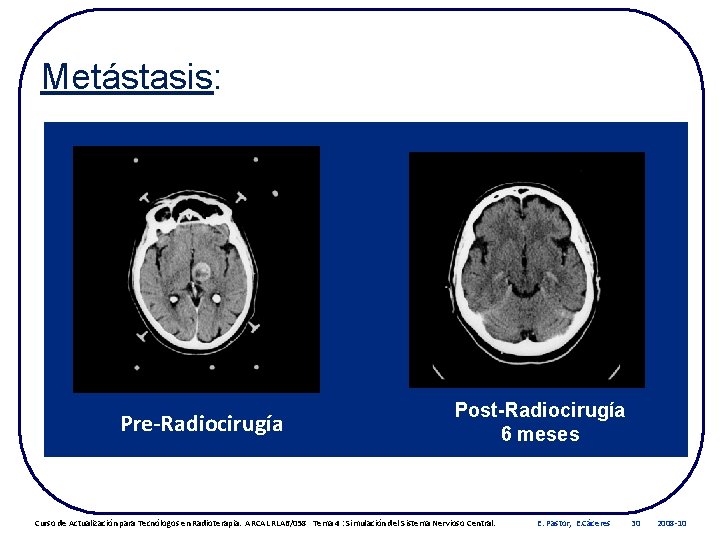Metástasis: Pre-Radiocirugía Post-Radiocirugía 6 meses Curso de Actualización para Tecnólogos en Radioterapia. ARCAL RLA