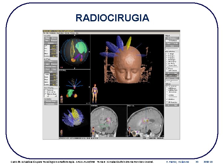 RADIOCIRUGIA Curso de Actualización para Tecnólogos en Radioterapia. ARCAL RLA 6/058 Tema 4 :