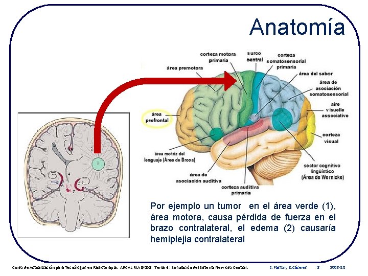 Anatomía Por ejemplo un tumor en el área verde (1), área motora, causa pérdida