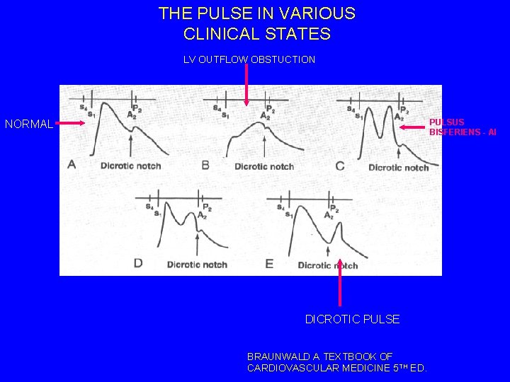 THE PULSE IN VARIOUS CLINICAL STATES LV OUTFLOW OBSTUCTION PULSUS BISFERIENS - AI NORMAL
