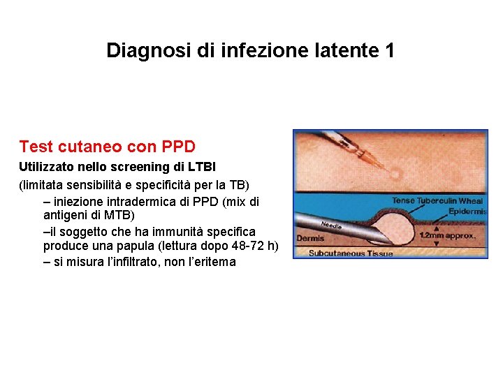 Diagnosi di infezione latente 1 Test cutaneo con PPD Utilizzato nello screening di LTBI