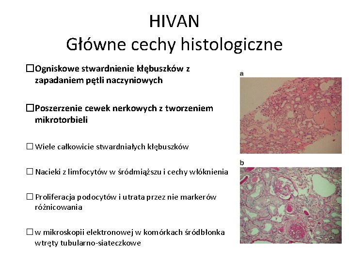 HIVAN Główne cechy histologiczne �Ogniskowe stwardnienie kłębuszków z zapadaniem pętli naczyniowych �Poszerzenie cewek nerkowych