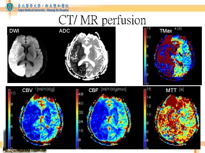 CT/ MR perfusion DWI TMax ADC CBV CBF MTT CT/ MR perfusion DWI TMax ADC CBV CBF MTT