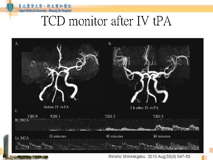 TCD monitor after IV t. PA Rinsho Shinkeigaku. 2010 Aug; 50(8): 547 -55. TCD monitor after IV t. PA Rinsho Shinkeigaku. 2010 Aug; 50(8): 547 -55.