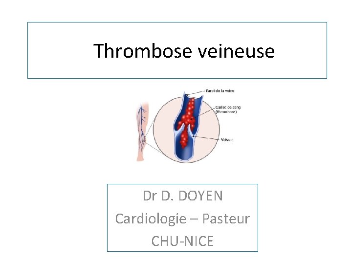 Thrombose veineuse Dr D. DOYEN Cardiologie – Pasteur CHU-NICE 