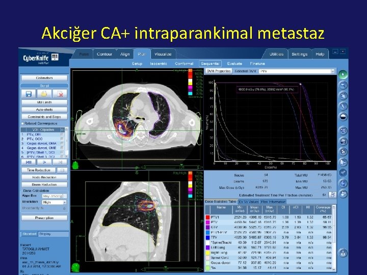 Akciğer CA+ intraparankimal metastaz 