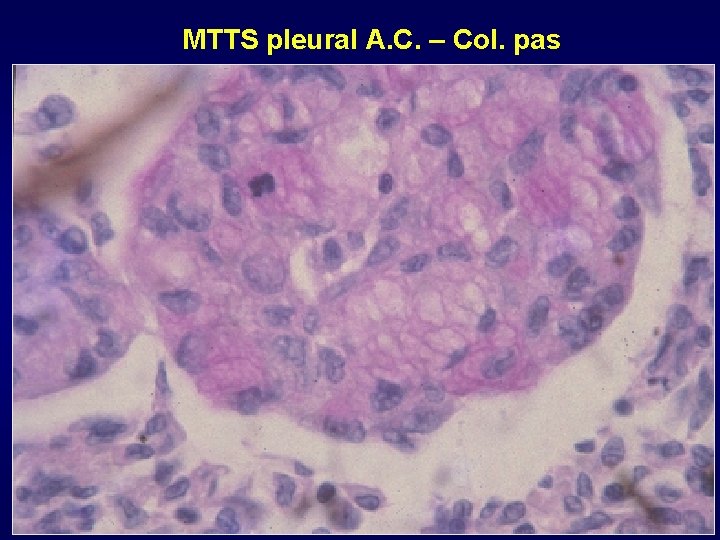 MTTS pleural A. C. – Col. pas MTTS pleural A. C. – Col. pas