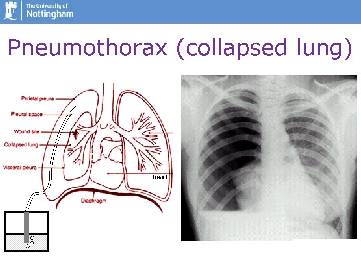 Pneumothorax (collapsed lung) • cysts can leak air causing pneumothorax • pneumothorax in LAM