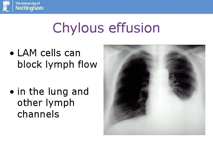 Chylous effusion • LAM cells can block lymph flow • in the lung and