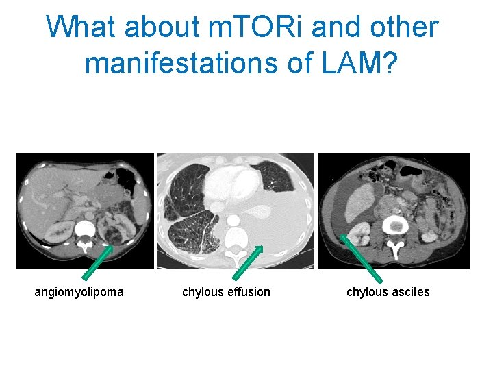 What about m. TORi and other manifestations of LAM? angiomyolipoma chylous effusion chylous ascites