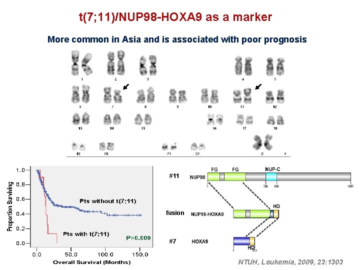 t(7; 11)/NUP 98 -HOXA 9 as a marker More common in Asia and is