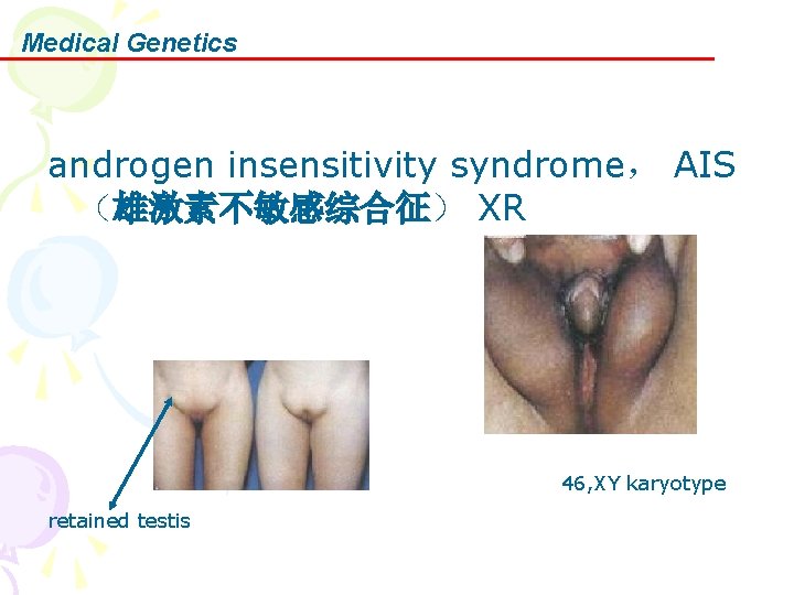 Medical Genetics androgen insensitivity syndrome， AIS （雄激素不敏感综合征） XR 46, XY karyotype retained testis 