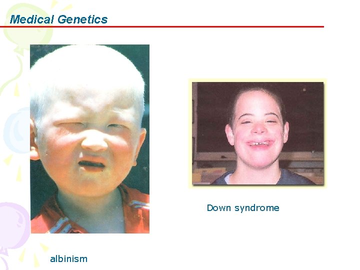 Medical Genetics Down syndrome albinism 