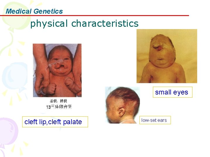 Medical Genetics physical characteristics small eyes cleft lip, cleft palate low-set ears 