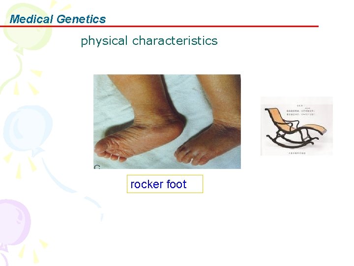 Medical Genetics physical characteristics rocker foot 