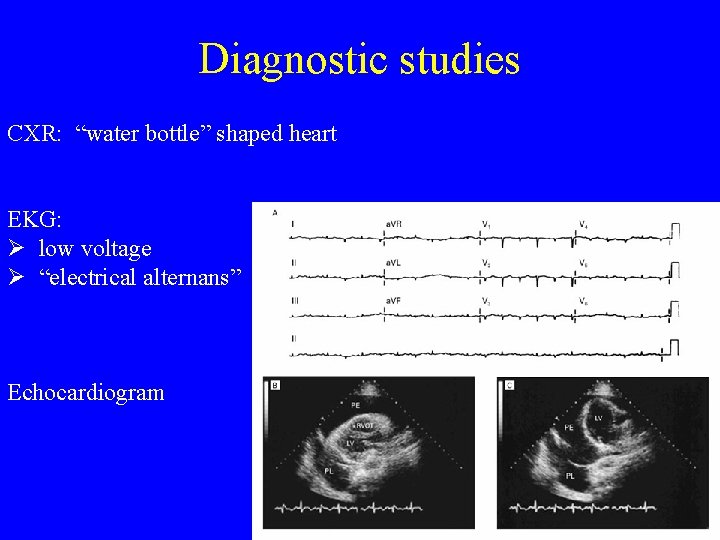 Diagnostic studies CXR: “water bottle” shaped heart EKG: Ø low voltage Ø “electrical alternans”