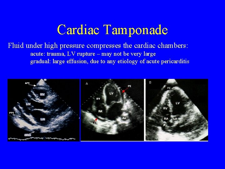 Cardiac Tamponade Fluid under high pressure compresses the cardiac chambers: acute: trauma, LV rupture