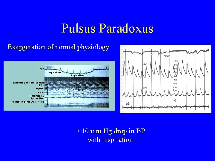 Pulsus Paradoxus Exaggeration of normal physiology > 10 mm Hg drop in BP with