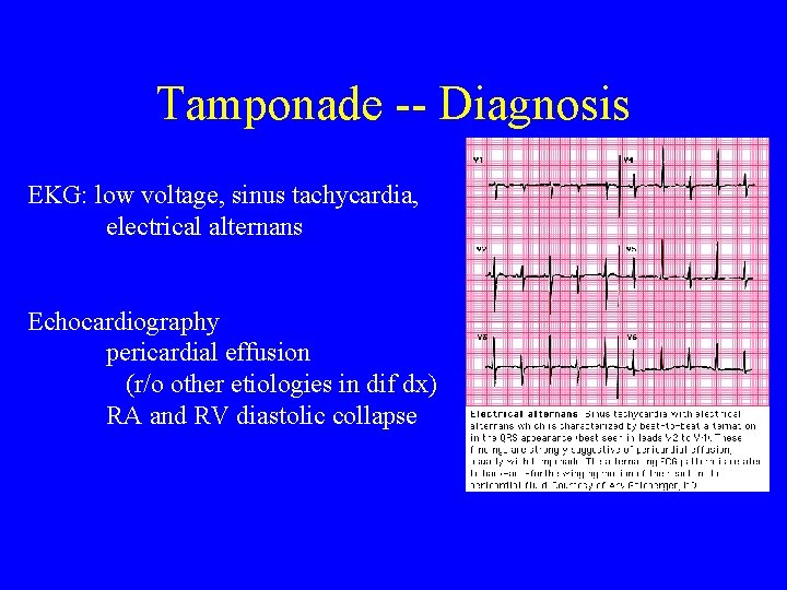 Tamponade -- Diagnosis EKG: low voltage, sinus tachycardia, electrical alternans Echocardiography pericardial effusion (r/o