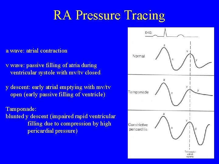 RA Pressure Tracing a wave: atrial contraction v wave: passive filling of atria during