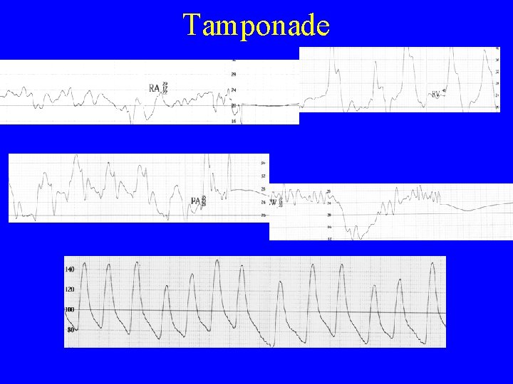 Tamponade 