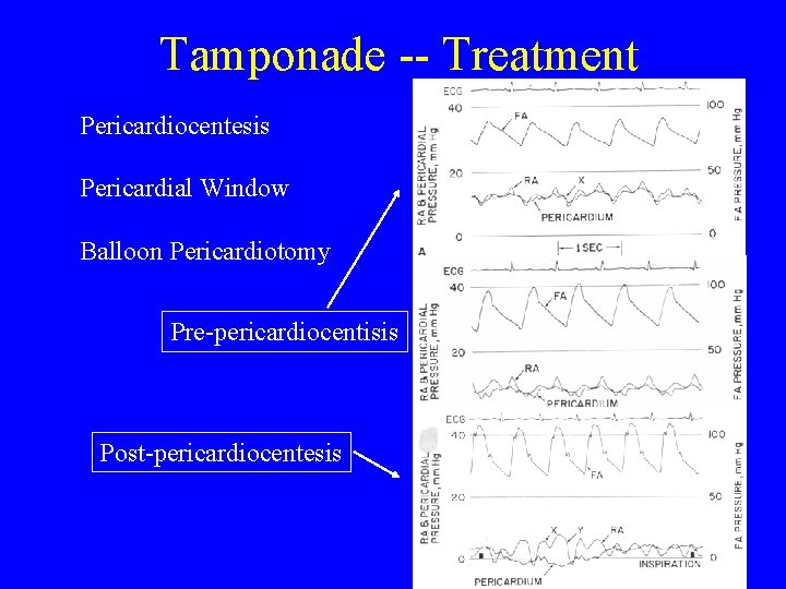 Tamponade -- Treatment Pericardiocentesis Pericardial Window Balloon Pericardiotomy Pre-pericardiocentisis Post-pericardiocentesis 