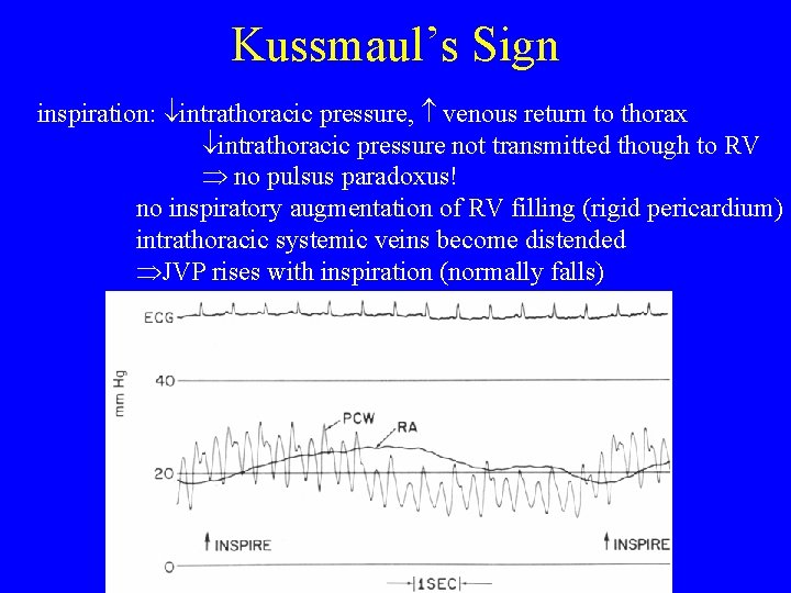 Kussmaul’s Sign inspiration: intrathoracic pressure, venous return to thorax intrathoracic pressure not transmitted though