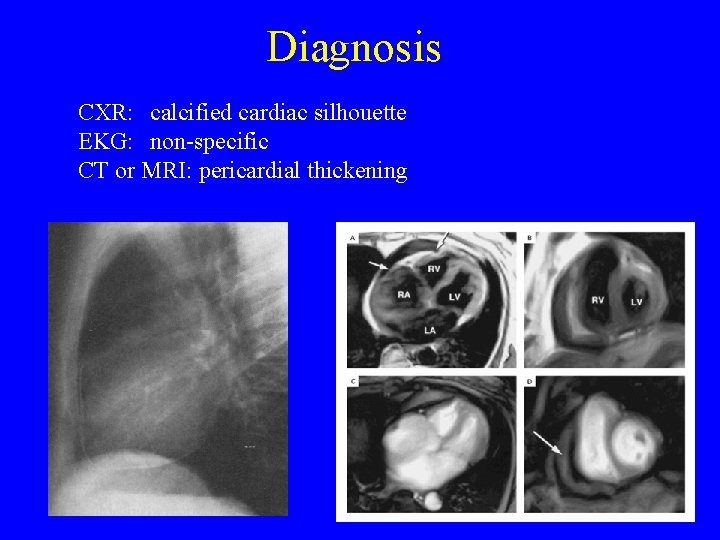 Diagnosis CXR: calcified cardiac silhouette EKG: non-specific CT or MRI: pericardial thickening 