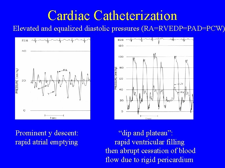 Cardiac Catheterization Elevated and equalized diastolic pressures (RA=RVEDP=PAD=PCW) Prominent y descent: rapid atrial emptying