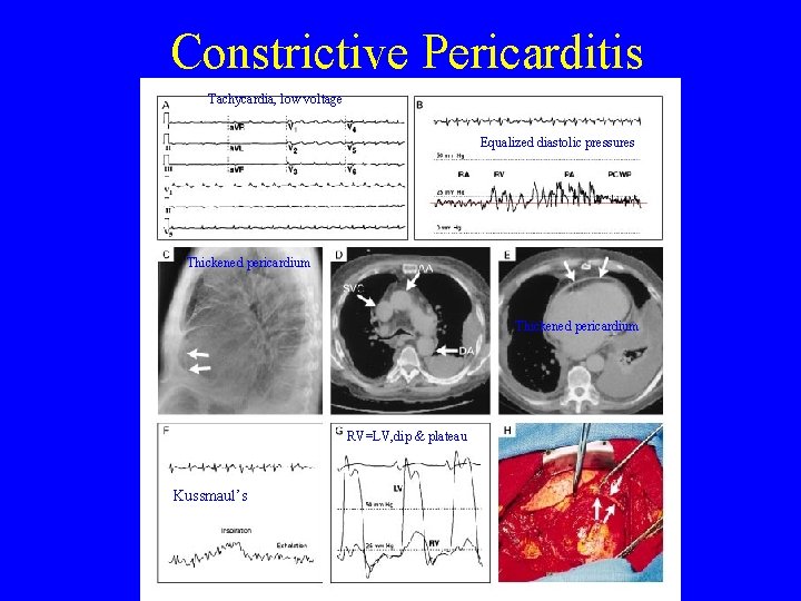 Constrictive Pericarditis Tachycardia, low voltage Equalized diastolic pressures Thickened pericardium RV=LV, dip & plateau