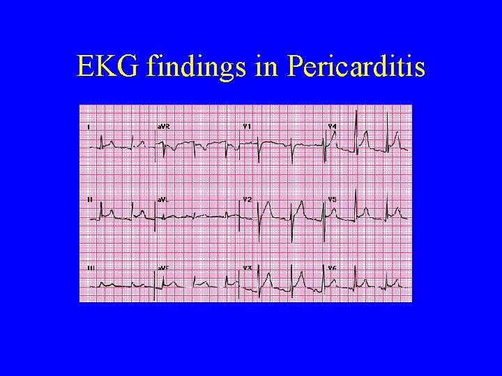 EKG findings in Pericarditis 