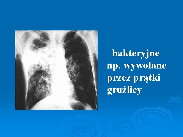  bakteryjne np. wywołane przez prątki gruźlicy 