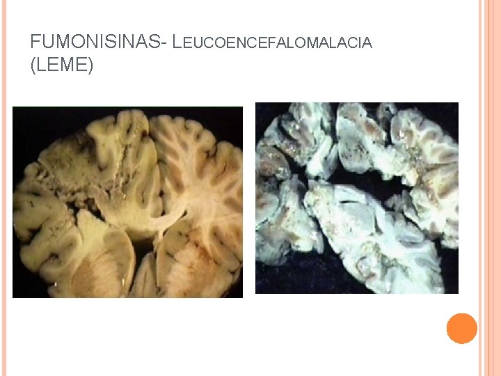 FUMONISINAS- LEUCOENCEFALOMALACIA (LEME) 