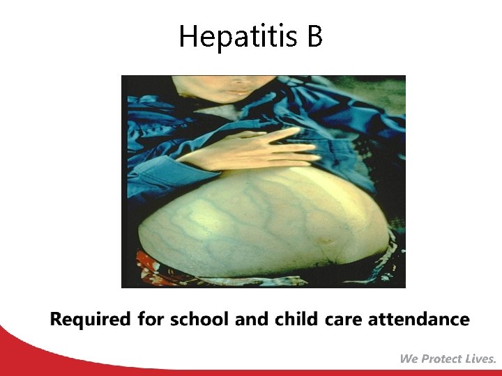 Hepatitis B 