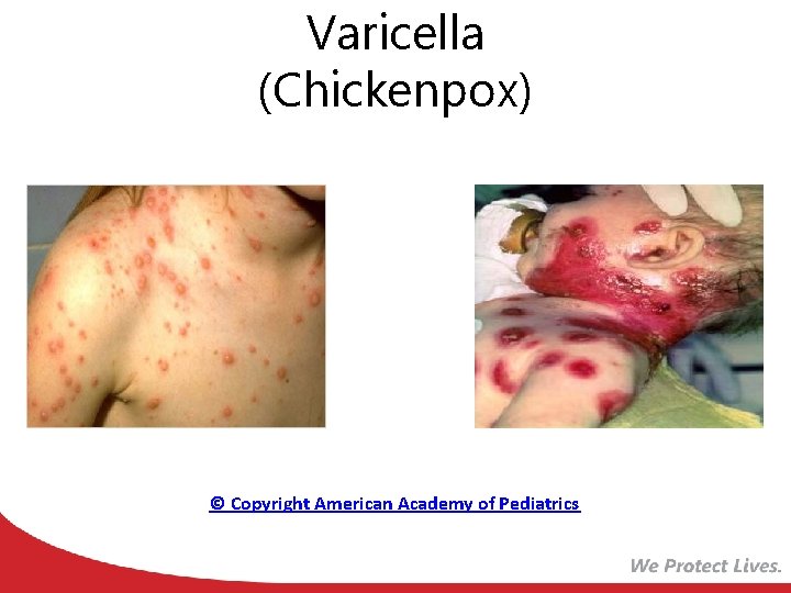 Varicella (Chickenpox) © Copyright American Academy of Pediatrics 