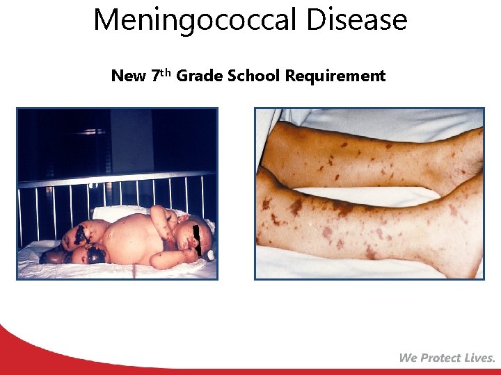 Meningococcal Disease New 7 th Grade School Requirement 