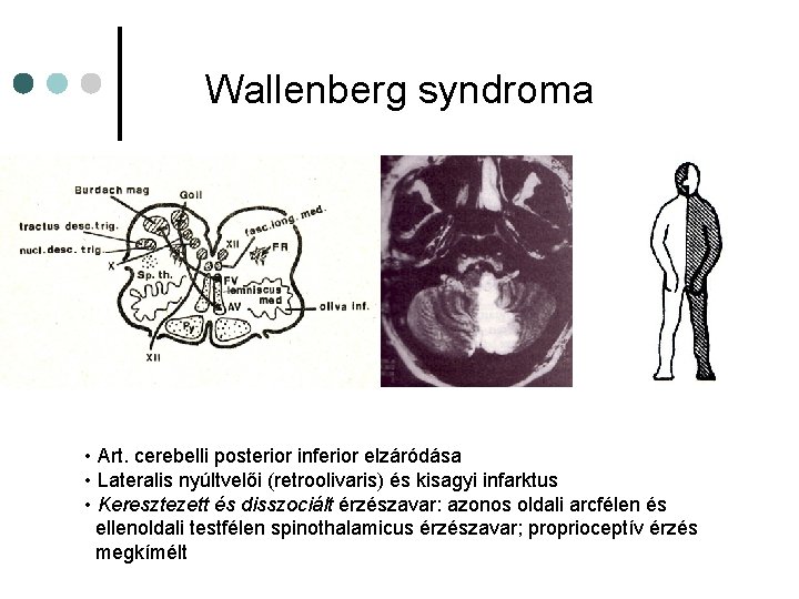 Wallenberg syndroma • Art. cerebelli posterior inferior elzáródása • Lateralis nyúltvelői (retroolivaris) és kisagyi Wallenberg syndroma • Art. cerebelli posterior inferior elzáródása • Lateralis nyúltvelői (retroolivaris) és kisagyi