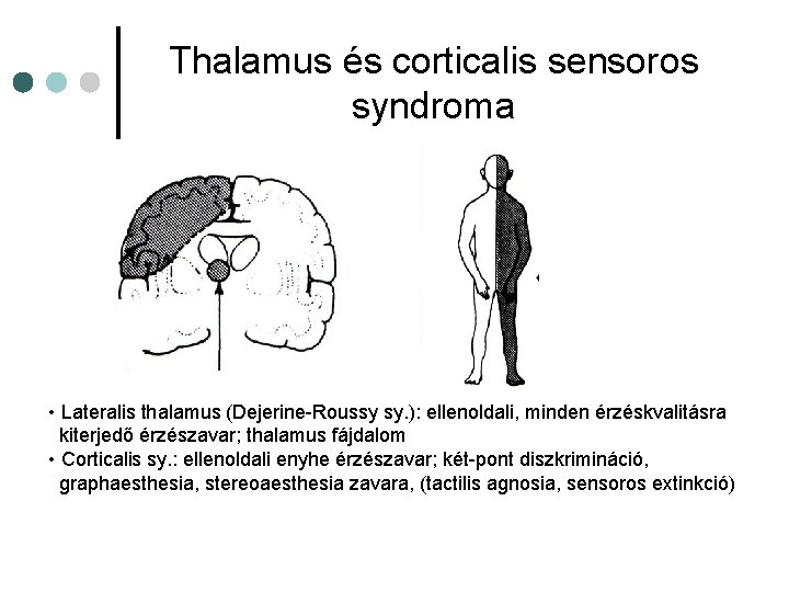 Thalamus és corticalis sensoros syndroma • Lateralis thalamus (Dejerine-Roussy sy. ): ellenoldali, minden érzéskvalitásra Thalamus és corticalis sensoros syndroma • Lateralis thalamus (Dejerine-Roussy sy. ): ellenoldali, minden érzéskvalitásra