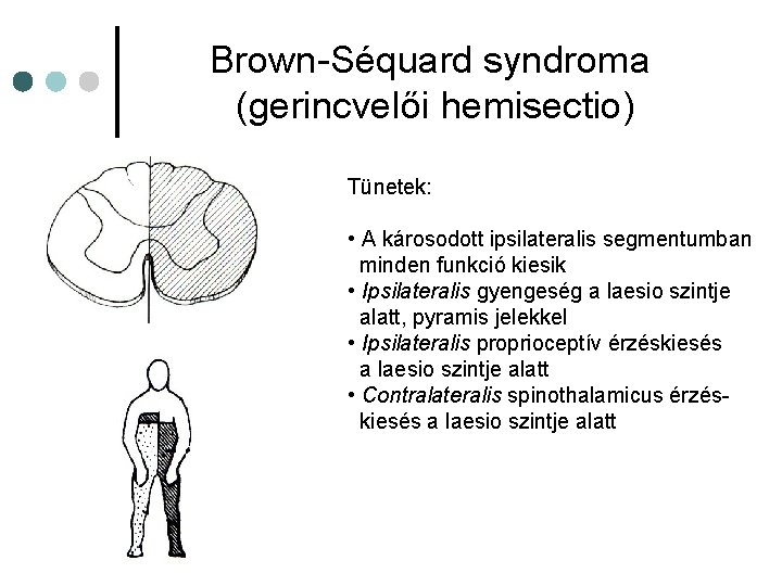 Brown-Séquard syndroma (gerincvelői hemisectio) Tünetek: • A károsodott ipsilateralis segmentumban minden funkció kiesik • Brown-Séquard syndroma (gerincvelői hemisectio) Tünetek: • A károsodott ipsilateralis segmentumban minden funkció kiesik •
