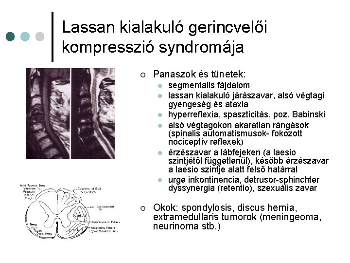 Lassan kialakuló gerincvelői kompresszió syndromája ¢ Panaszok és tünetek: l l l ¢ segmentalis Lassan kialakuló gerincvelői kompresszió syndromája ¢ Panaszok és tünetek: l l l ¢ segmentalis
