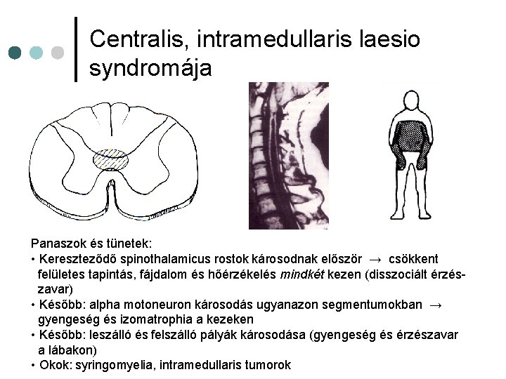 Centralis, intramedullaris laesio syndromája Panaszok és tünetek: • Kereszteződő spinothalamicus rostok károsodnak először → Centralis, intramedullaris laesio syndromája Panaszok és tünetek: • Kereszteződő spinothalamicus rostok károsodnak először →