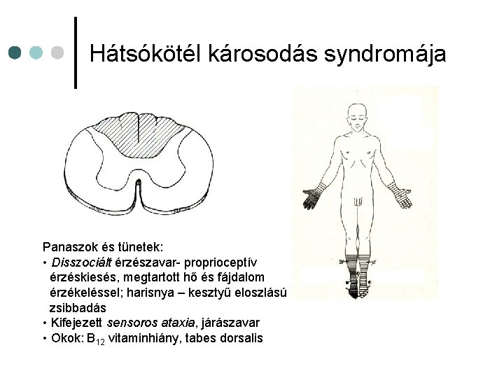 Hátsókötél károsodás syndromája Panaszok és tünetek: • Disszociált érzészavar- proprioceptív érzéskiesés, megtartott hő és Hátsókötél károsodás syndromája Panaszok és tünetek: • Disszociált érzészavar- proprioceptív érzéskiesés, megtartott hő és