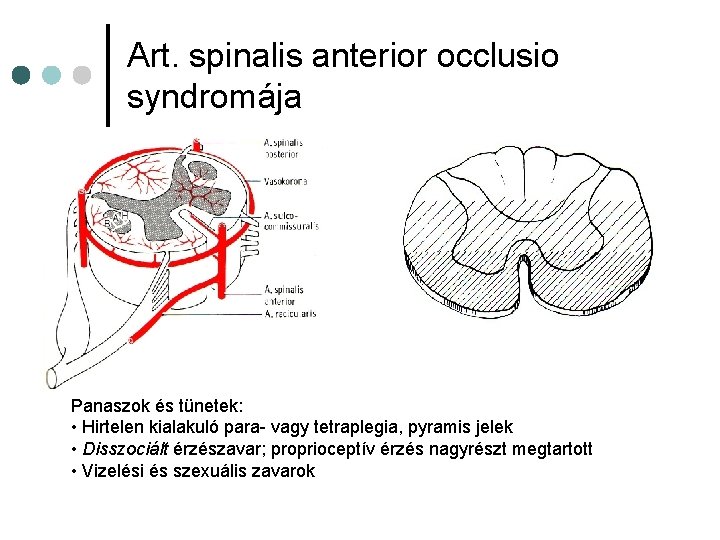 Art. spinalis anterior occlusio syndromája Panaszok és tünetek: • Hirtelen kialakuló para- vagy tetraplegia, Art. spinalis anterior occlusio syndromája Panaszok és tünetek: • Hirtelen kialakuló para- vagy tetraplegia,