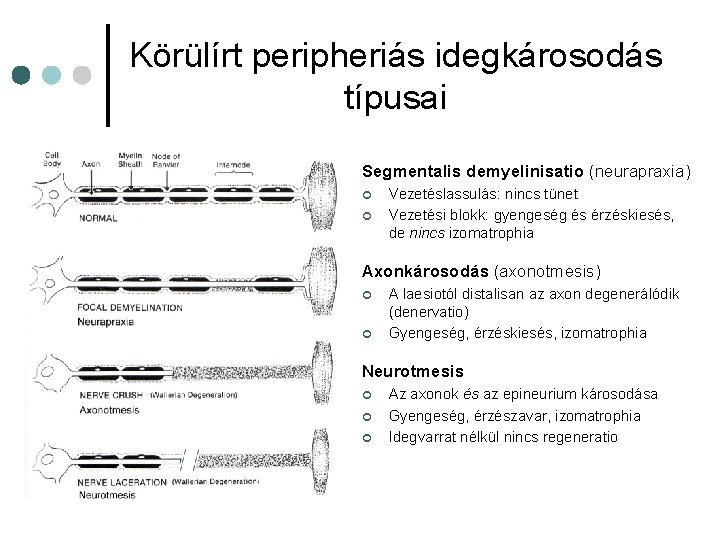 Körülírt peripheriás idegkárosodás típusai Segmentalis demyelinisatio (neurapraxia) ¢ ¢ Vezetéslassulás: nincs tünet Vezetési blokk: Körülírt peripheriás idegkárosodás típusai Segmentalis demyelinisatio (neurapraxia) ¢ ¢ Vezetéslassulás: nincs tünet Vezetési blokk: