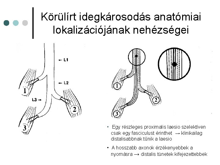 Körülírt idegkárosodás anatómiai lokalizációjának nehézségei • Egy részleges proximalis laesio szelektíven csak egy fasciculust Körülírt idegkárosodás anatómiai lokalizációjának nehézségei • Egy részleges proximalis laesio szelektíven csak egy fasciculust