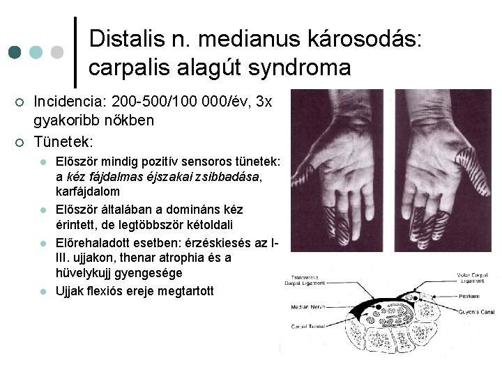 Distalis n. medianus károsodás: carpalis alagút syndroma ¢ ¢ Incidencia: 200 -500/100 000/év, 3 Distalis n. medianus károsodás: carpalis alagút syndroma ¢ ¢ Incidencia: 200 -500/100 000/év, 3