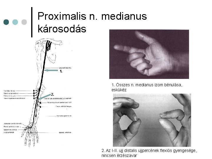 Proximalis n. medianus károsodás 1. Összes n. medianus izom bénulása, eskükéz 2. Az I-II. Proximalis n. medianus károsodás 1. Összes n. medianus izom bénulása, eskükéz 2. Az I-II.