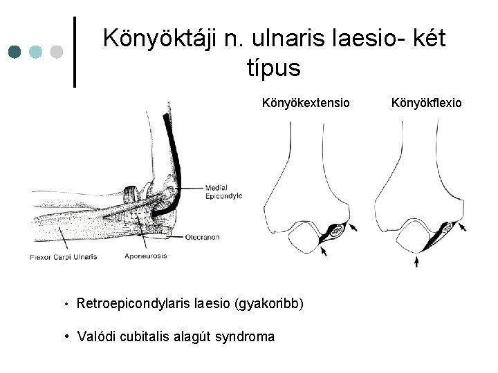Könyöktáji n. ulnaris laesio- két típus Könyökextensio • Retroepicondylaris laesio (gyakoribb) • Valódi cubitalis Könyöktáji n. ulnaris laesio- két típus Könyökextensio • Retroepicondylaris laesio (gyakoribb) • Valódi cubitalis